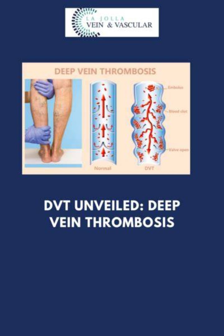 (2023) How To Code DVT ICD 10 List With Codes & Guidelines