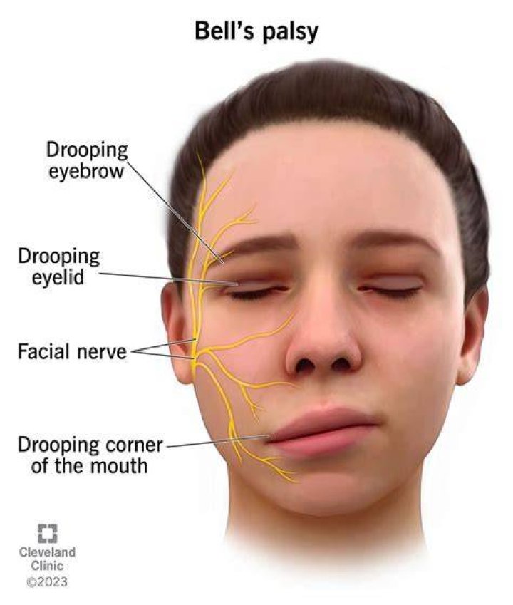 Bells palsy by SteveH51 on DeviantArt