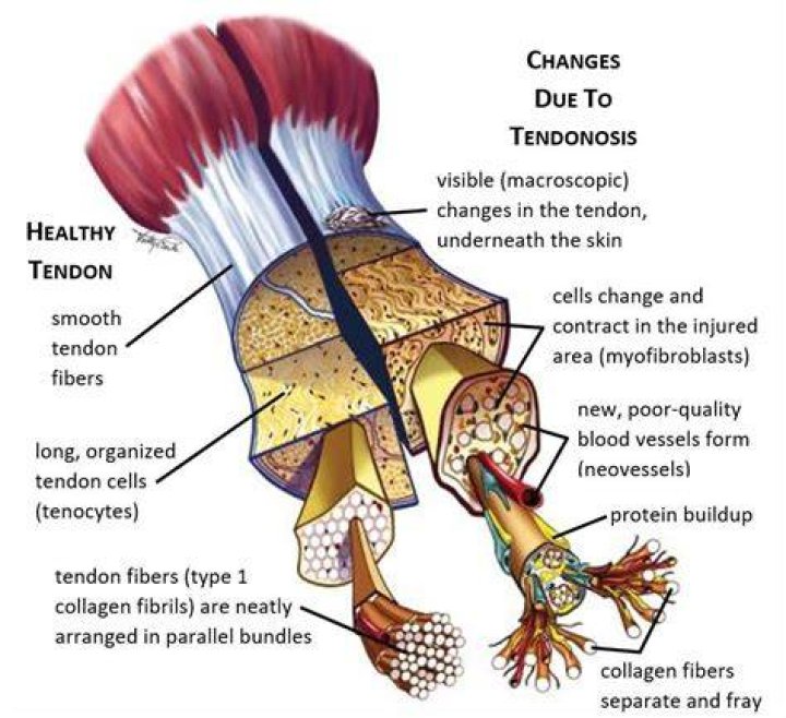 Can Tendons Heal Naturally? 4 Myths and Truths