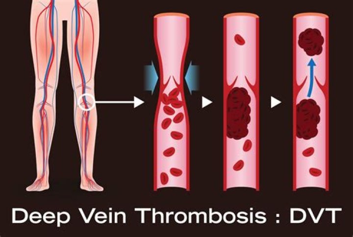 Deep Vein Thrombosis Dvt Explained Stinkyquasar