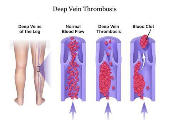 Deep Vein Thrombosis (DVT) Fayette Surgical Associates