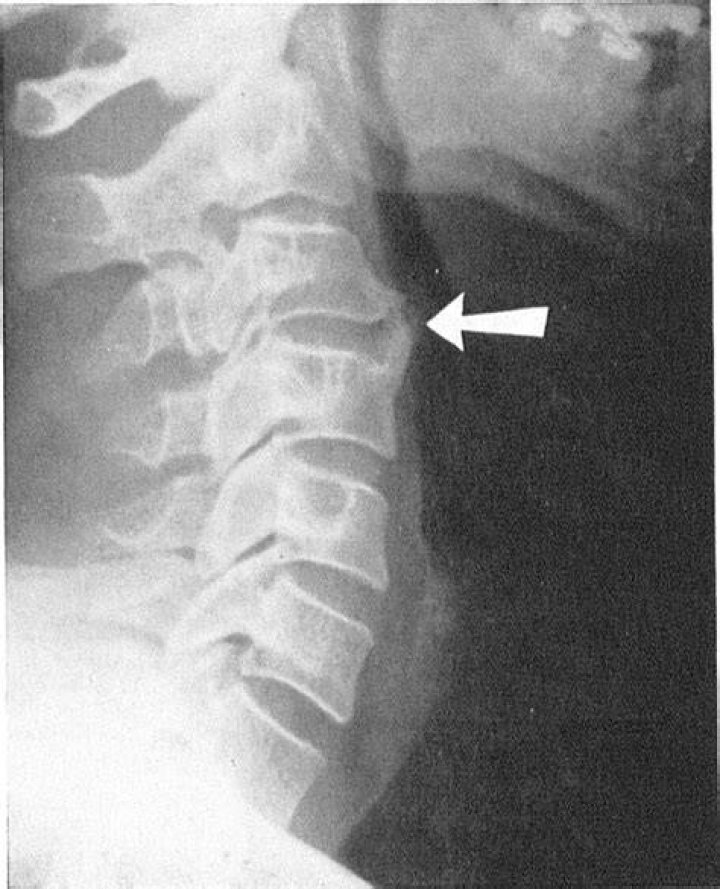 Dysphagia and Hypertrophic Spurring of the Cervical Spine NEJM