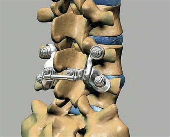 Facet Joint Surgery