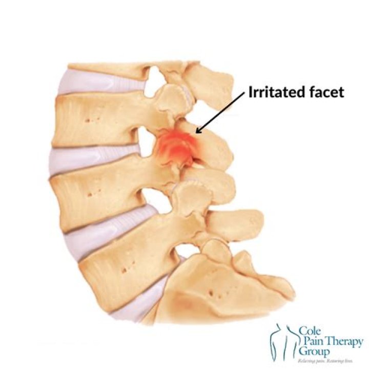 Facet Syndrome of the Lumbar Spine