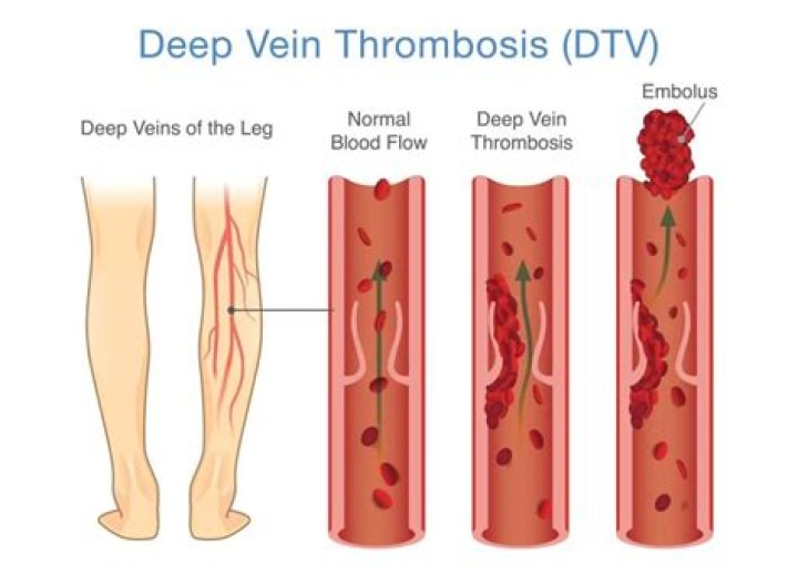 Facts About Deep Vein Thrombosis (ICD 10 Code I82.40) Veins CNY