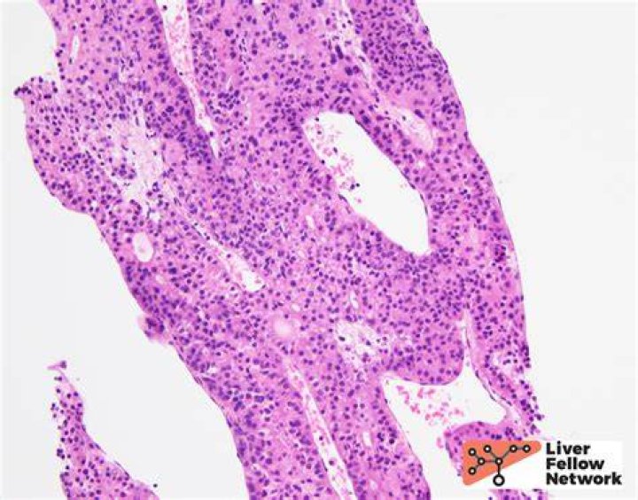 Figure 22 from Pathology of myxomatous mitral valve disease in the dog