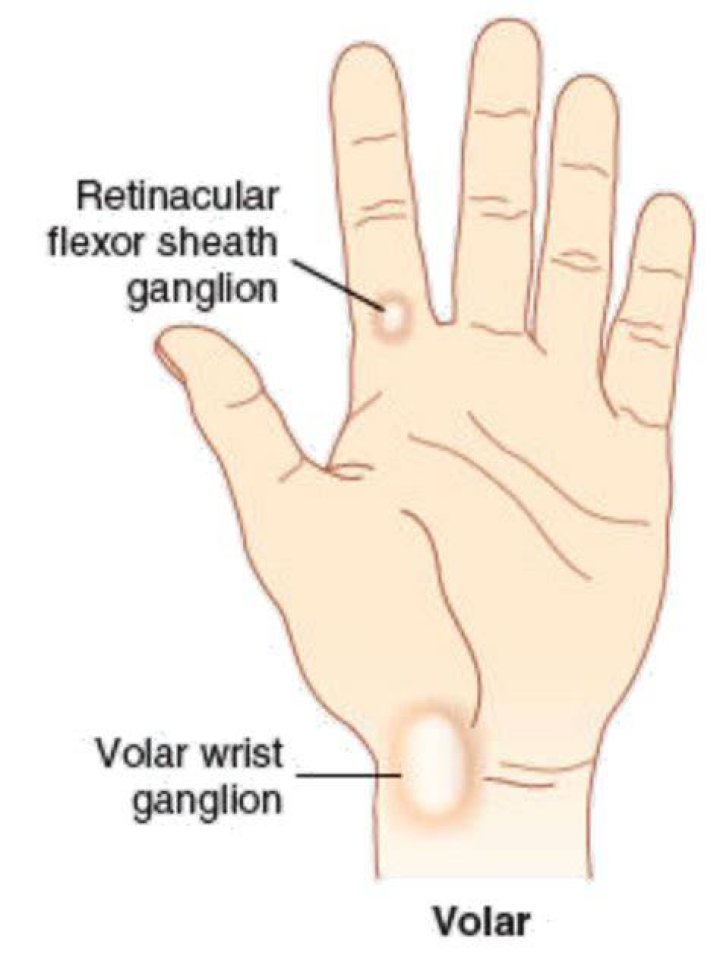 Ganglion Cysts Volar Retinacular Cysts OSMI Fort Worth