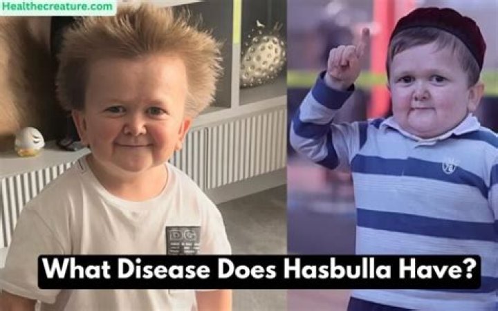 Hasbulla Disease What Is Hasbulla Condition? What Disorder Does