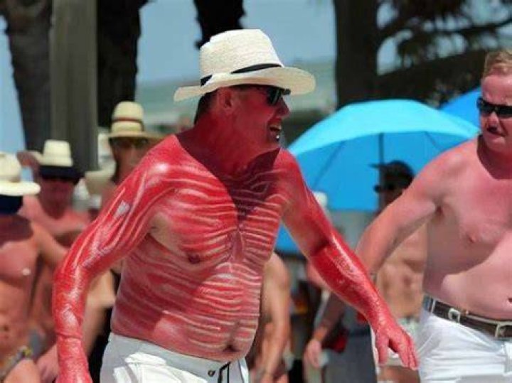Hilarious Sunburn Quips: The Ultimate Guide To Sunburnt Humor
