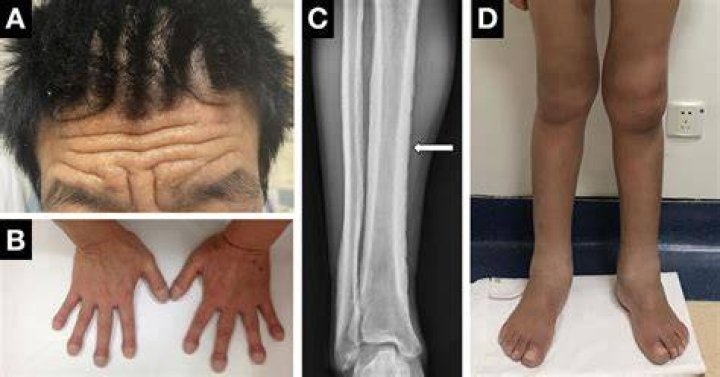 Hypertrophic Osteoarthropathy Stock Image C014/4438 Science Photo