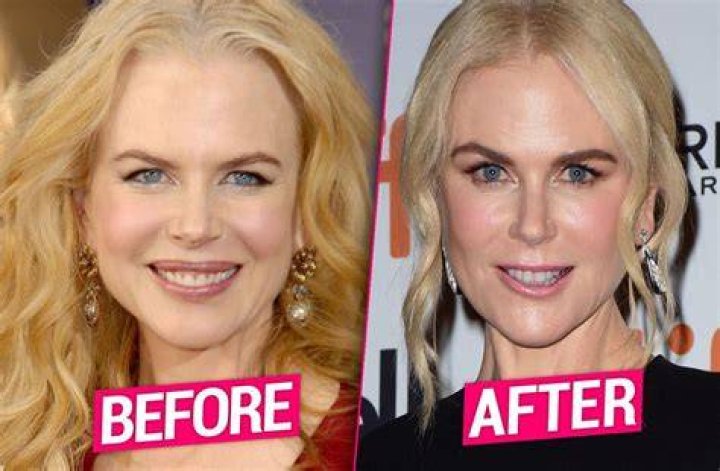 Is Nicole Kidman's Plastic Surgery A Masterpiece Or A Mistake?
