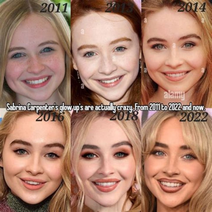 Is Sabrina Carpenter's Chin Transformation The Result Of A Chin Implant?