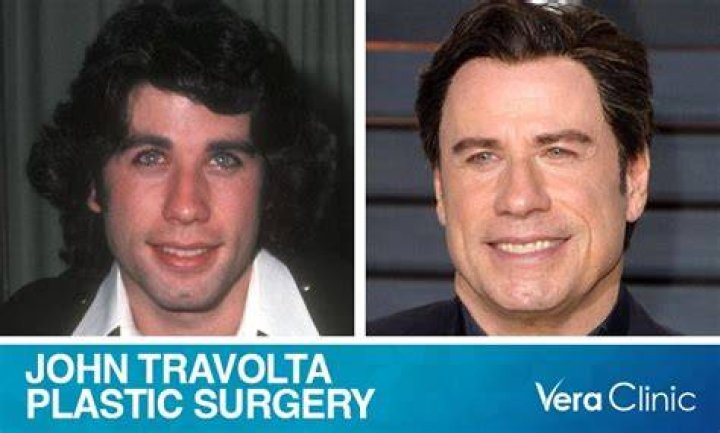 John Travolta Plastic Surgery Details John travolta, Plastic surgery