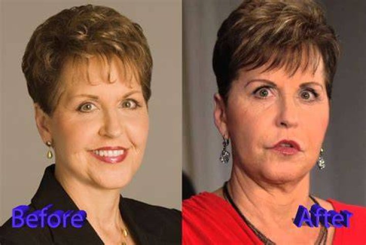 Joyce Meyer Plastic Surgery A Huge Flop