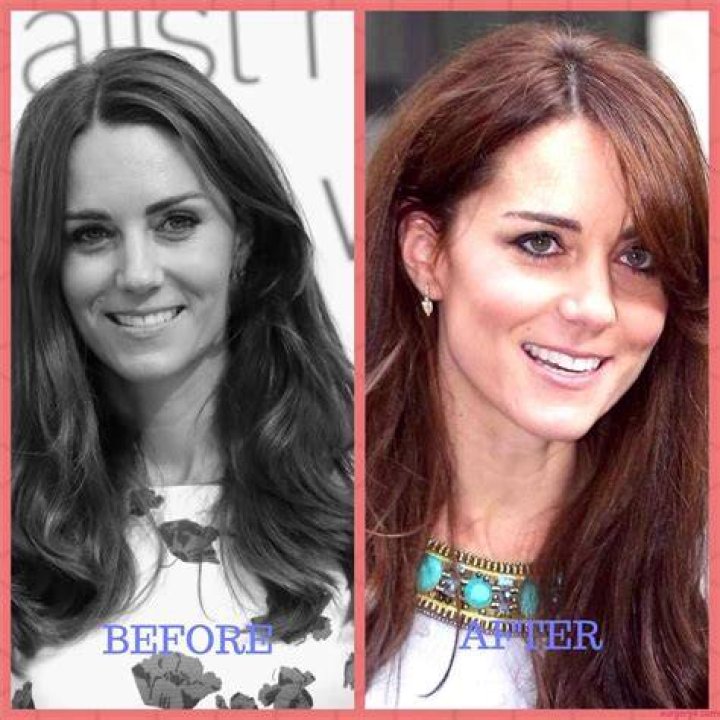 Kate Middleton's Plastic Surgery: A Detailed Look At The Rumors And Facts