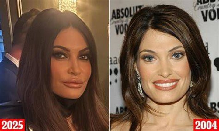 Kimberly Guilfoyle's Lip Filler Journey: A Closer Look
