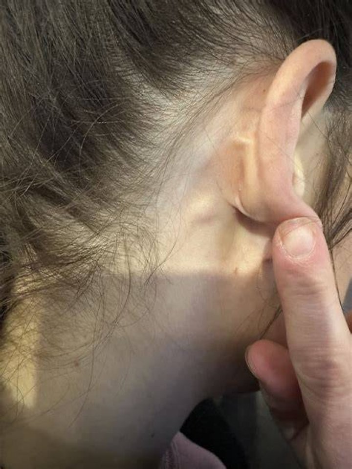 Lump Behind My Ear What Do I Need to Know? LifeMD