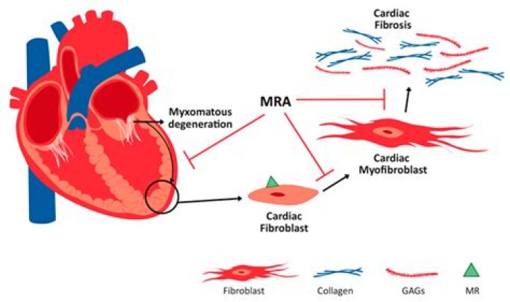 Opinions on Myxomatous degeneration