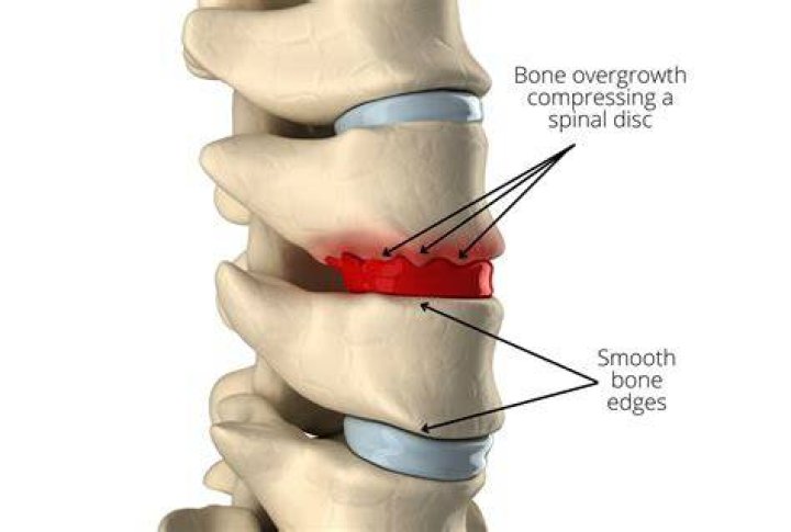 Osteophytes