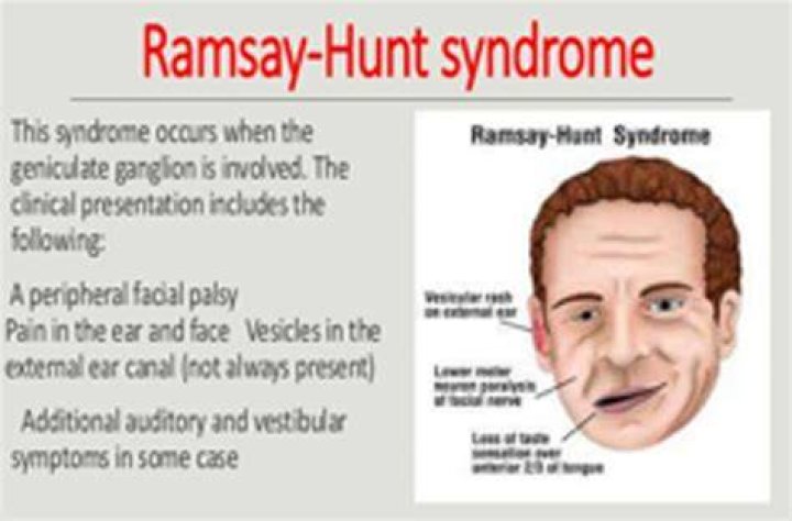 Ramsay Hunt Syndrome