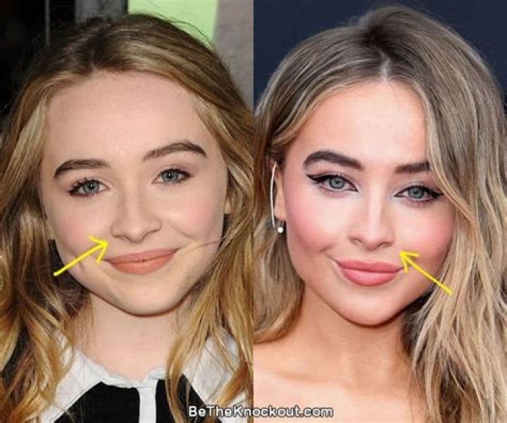 Sabrina Carpenter Plastic Surgery Nose Job, Lip Shots and Botox