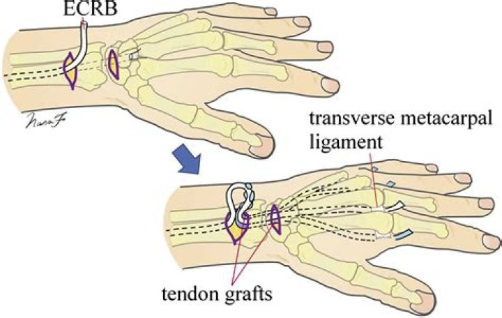 Tendon Transfers of the Hand Florida Orthopaedic Institute