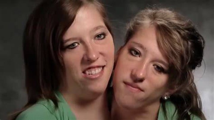The Tragic Tale Of The Hensel Twins: Abby And Brittany