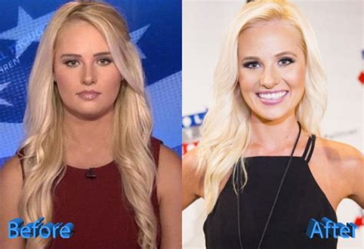 Tomi Lahren Before And After Plastic Surgery