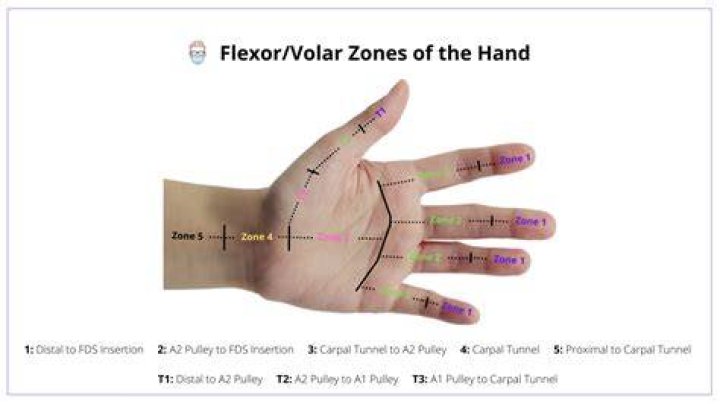 Volar Hand