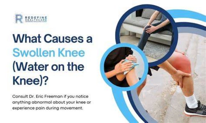 Water On The Knee (Knee Effusion) Treatment, symptoms, and causes
