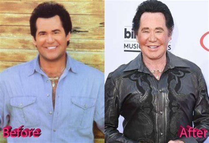 Wayne Newton Before and After Plastic Surgery